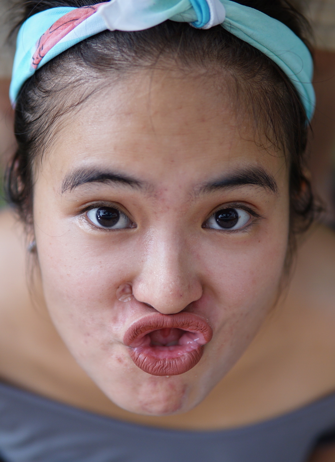 Melawan Jerawat: Nyobain Acne Patch